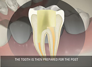 Root canal  - General Dentistry Mississauga